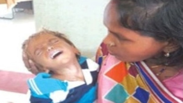 MP: कुपोषण से टाई गांव के बालक संतोष की आंखे हुई खराब MP: कुपोषण से टाई गांव के बालक संतोष की आंखे हुई खराब