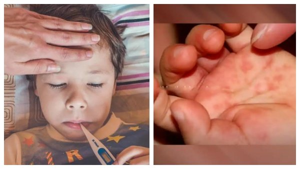 Uttarakhand Health department issued guidelines regarding tomato flu disease dangerous for children Uttarakhand Health department issued guidelines regarding tomato flu disease dangerous for children