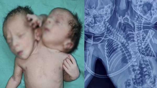 भ्रुण विकसित होने के दौरान होता है ऐसा