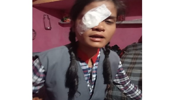 केंद्रीय विद्यालय की शिक्षिका ने छात्रा के आंख में स्केल मारा केंद्रीय विद्यालय की शिक्षिका ने छात्रा के आंख में स्केल मारा