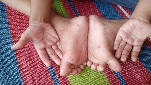 2. मंकीपॉक्स 2. मंकीपॉक्स