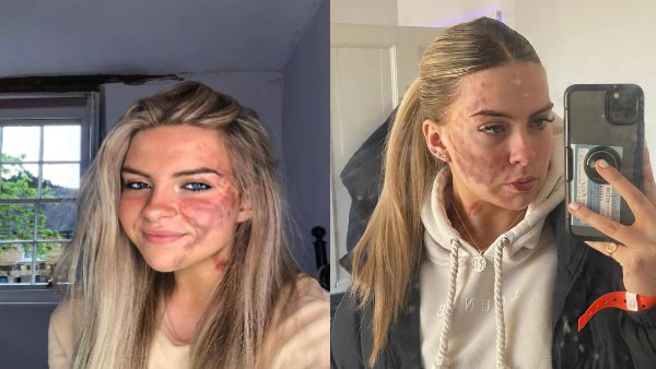 साल 2015 में पहली बार हुआ बीमारी का अहसास