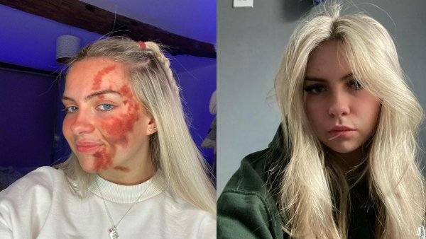 19 साल की नैंसी को लगा अजीब रोग