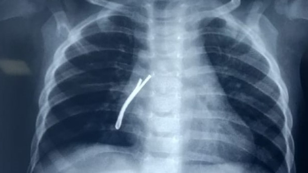 बच्ची को इंदौर से भोपाल एम्स किया रेफर बच्ची को इंदौर से भोपाल एम्स किया रेफर