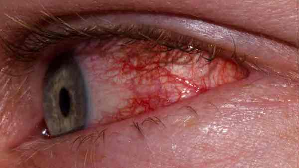 मद्रास आई के लक्षण क्या हैं ?