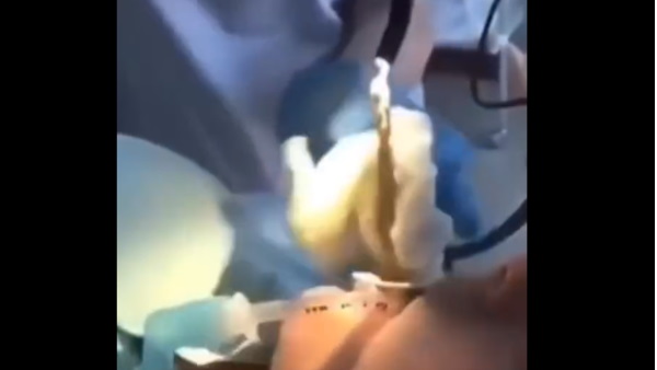 डॉक्टरों ने महिला के मुंह से निकाला सांप