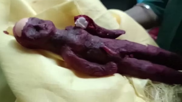 महिला ने कहा - गर्भपात हो गया, अविकसित बच्चे ने लिया जन्म