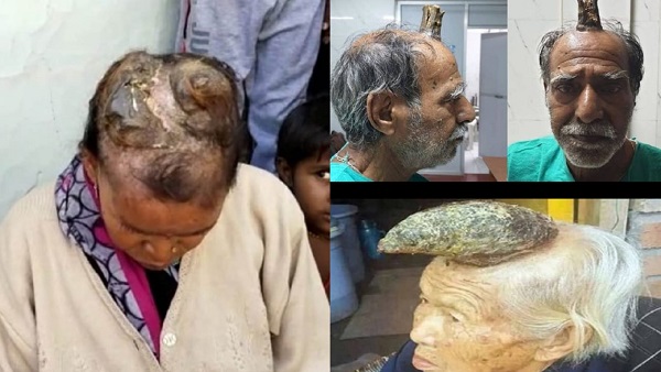 'सेबेसियय हार्न' कहा जाता है, काफी दुर्लभ केस होते हैं 'सेबेसियय हार्न' कहा जाता है, काफी दुर्लभ केस होते हैं