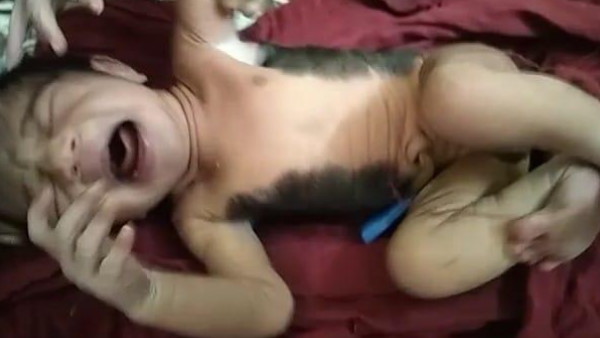 बच्चे के शरीर पर हुए हैं बाल