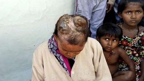 मिमियाबाई के सिर में से उग रहे दो सींग, दर्द भी होता है मिमियाबाई के सिर में से उग रहे दो सींग, दर्द भी होता है