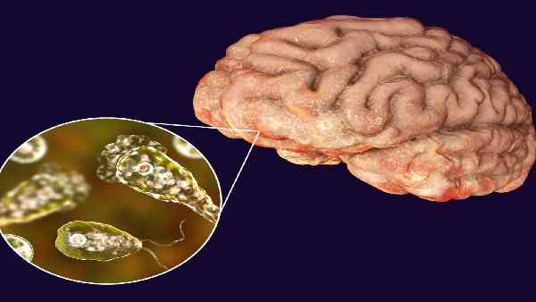 ब्रेन-ईटिंग अमीबा का भारत में पहला केस ?
