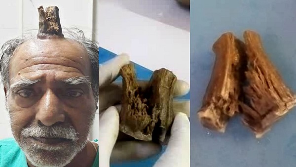 सागर के श्यामलाल यादव के सिर पर भी उगा था सींग सागर के श्यामलाल यादव के सिर पर भी उगा था सींग