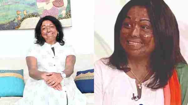 दहेज दानवों ने जलाया, नहीं मानी हार, हासिल की नई जिंदगी