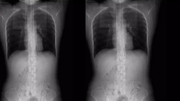 डॉक्‍टरों ने बताया कैसे खांसने की वजह से टूटी पसली 