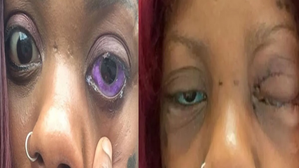टैटू बनवाने के बाद से आंखों का हुआ ये हाल 