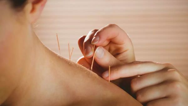 एक्यूपंचर भी उपचार का प्रचलित तरीका एक्यूपंचर भी उपचार का प्रचलित तरीका