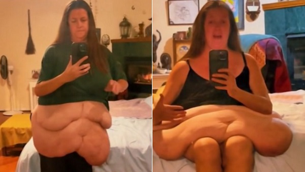 वेट लूट के बाद ढीली हो गई महिला की त्वचा वेट लूट के बाद ढीली हो गई महिला की त्वचा