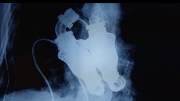  दिल नहीं था फिर भी वो जिंदा थे और सांस ले रहे थे