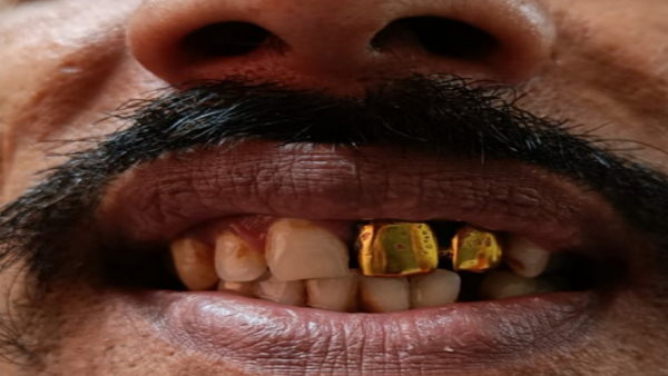 दो सोने के दांतों के कारण खुली पोल दो सोने के दांतों के कारण खुली पोल