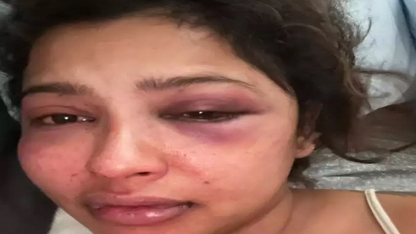 अनिका ने शेयर की चेहरे पर चोट लगी तस्वीर