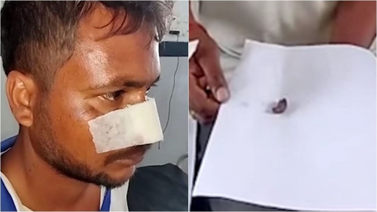  हथेली पर कटी नाक लेकर अस्पताल पहुंचा, बोला पड़ोसी ने दांतों से काट दी