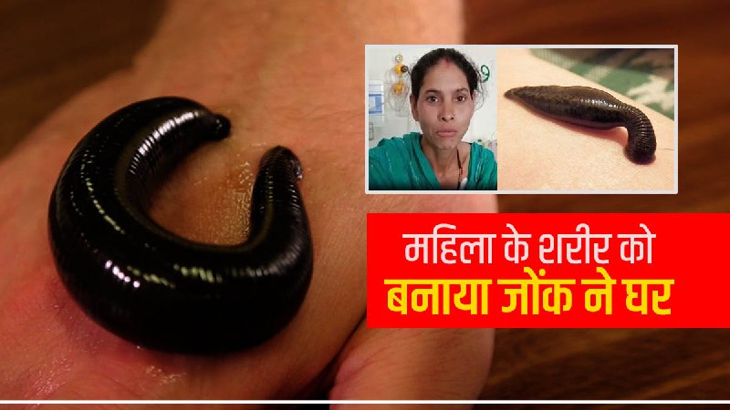 Blood was coming from the woman mouth for a month dangerous leech had reached inside the body Blood was coming from the woman mouth for a month dangerous leech had reached inside the body