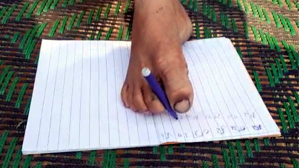 rampur Waseem got new imported censored hands from America with help of district administration rampur Waseem got new imported censored hands from America with help of district administration