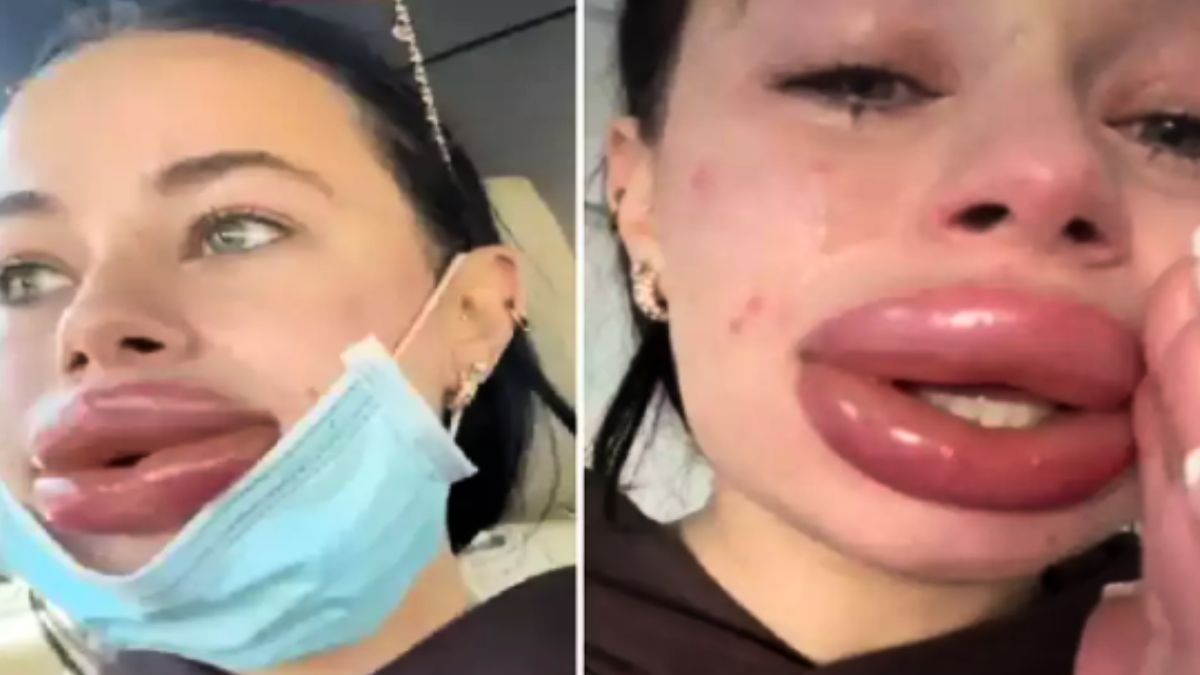 lip filler lip filler