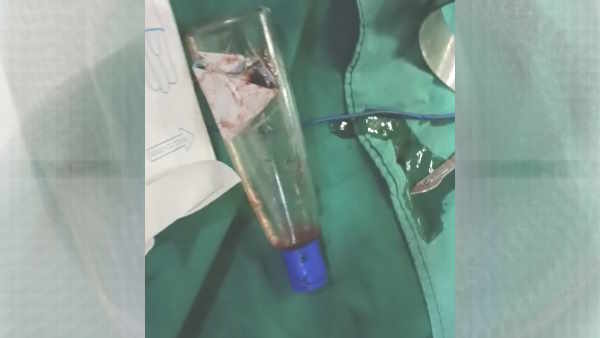 Basti 10 inch plastic bottle in patient stomach through operation in Shri Krishna Mission Hospital