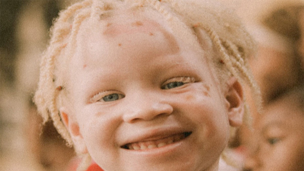 What is albinism or skin discoloration know its causes
