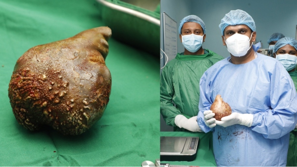large-kidney-stone-in-Sri-Lanka