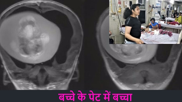 Fetus in fetu 7 months baby was pregnant 2nd baby of 2 kg was taken out by operation in prayagraj Fetus in fetu 7 months baby was pregnant 2nd baby of 2 kg was taken out by operation in prayagraj