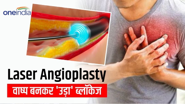 laser angioplasty