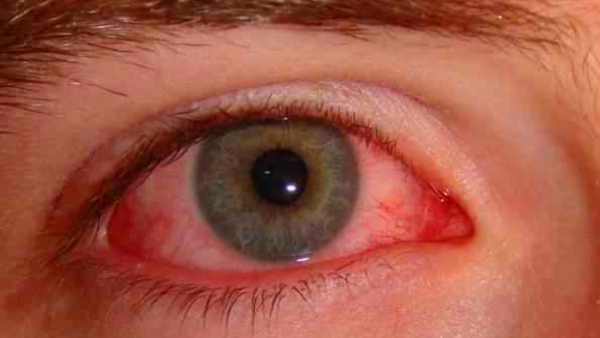 conjunctivitis 