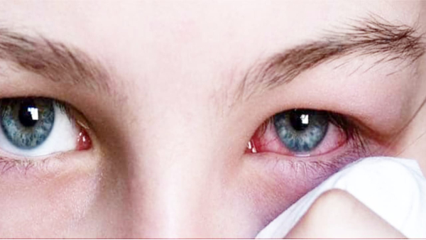 Eye Flu Cases in Satna