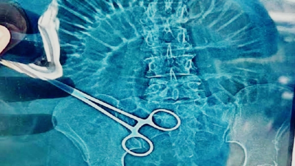 During operation in hospital, woman lost her life due to scissors in stomach, doctor was negligent