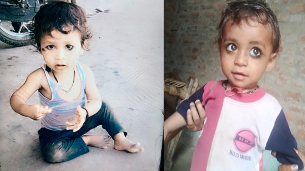 Hamirpur Chickenpox killed 3 children in the same village 1 dozen other children also infected 