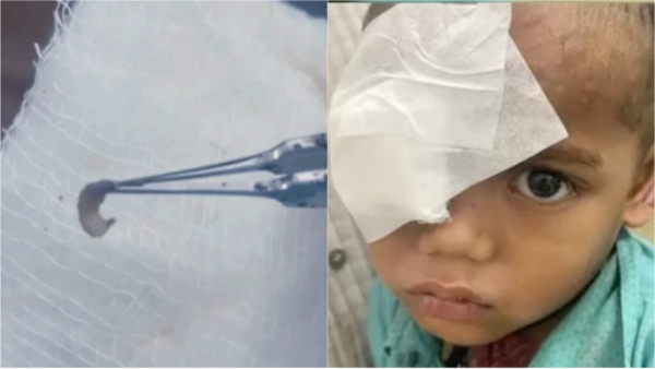 A live worm entered in the childs eye A live worm entered in the childs eye