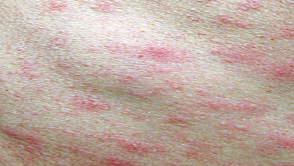 Scrub Typhus in Odisha