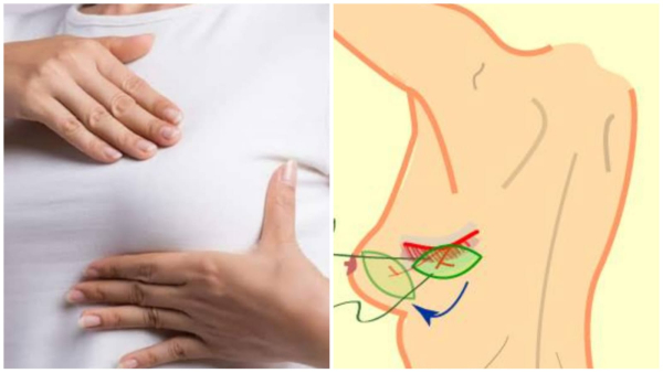 Successful operation of breast cancer of 40 year old woman with the help of plastic surgery in AIIMS Successful operation of breast cancer of 40 year old woman with the help of plastic surgery in AIIMS