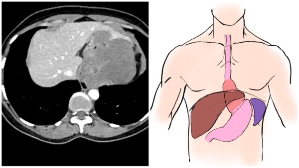 AIIMS Complex surgery for tumor in lower part of the esophagus of 34-year-old woman, Dr. Ankit Jain