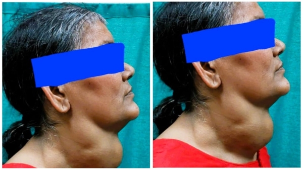 Successful operation of big lump of goiter in AIIMS Bhopal, new life to 56 year old woman