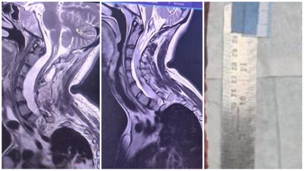 World longest spinal tumor operation done in AIIMS Bhopal, 22 year old woman