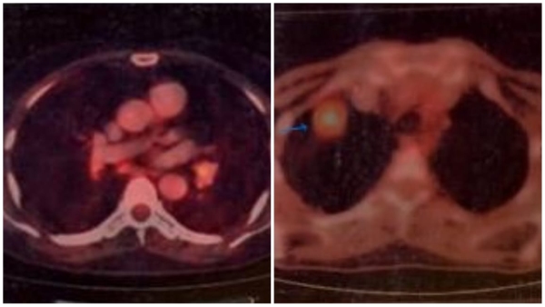 Two stage 4 cancer patients got new life through immunotherapy, successful treatment in AIIMS Bhopal.