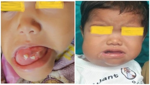 Successful complex operation of lower jaw of 11 month old girl from Vidisha in AIIMS Bhopal