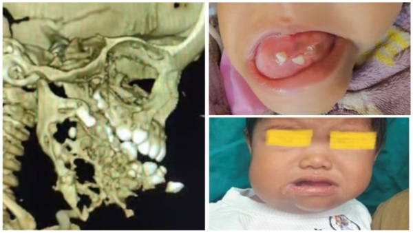 Successful complex operation of lower jaw of 11 month old girl from Vidisha in AIIMS Bhopal