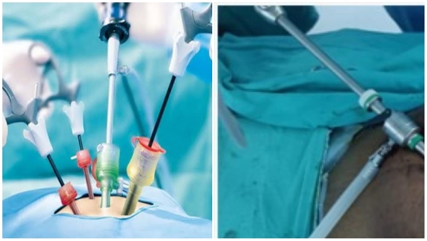 AIIMS Successful operation of spleen of woman suffering from rare blood disorder through laparoscopy