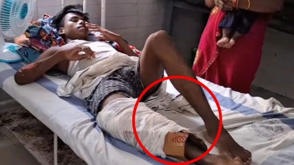Muzaffarpur Health Centre Plasters Man Fractured Leg With Cardboard