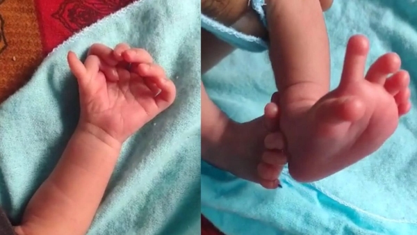 Baby born with 25 figures