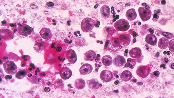 Naegleria Fowleri Infection Naegleria Fowleri Infection